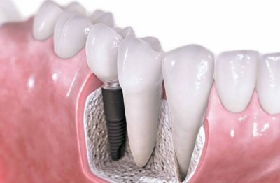 Созданы зубные импланты, которые способны сами врастать в кость