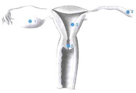 Забеременела без труб естественным путем. Маточное бесплодие. Шеечная беременность. Сперматозоиды попадают в полость матки. Форум беременности с одной трубой.
