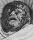 Герпетиформная экзема Капоши (eczema herpefiforme Kaposi)- вирусное заболевание младенцев