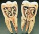 Краткие исторические сведения о борьбе с "зубным камнем"
