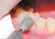 Шлифование и полирование поверхности зубов