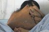 Хирурги избавят китайца от гигантской опухоли на лице